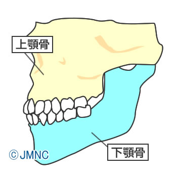 上顎骨が前突 / 下顎骨が後退すると、骨格要因の出っ歯になります。