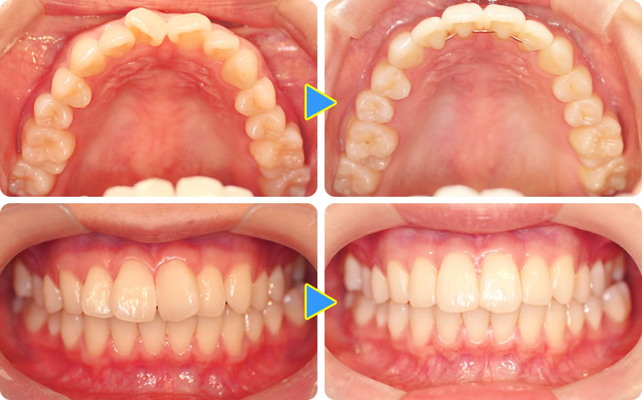 出っ歯￥ウィンギングの矯正治療前後写真