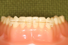 表側矯正装置の写真です。写真のワイヤーはゴールドを使用していますが、他にも白・シルバーを使用しています。歯の色に一番近いものを選んで使用しています。