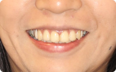 八重歯治療6か月後・顔貌写真