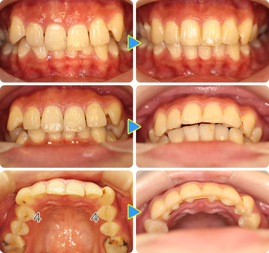 八重歯を部分矯正治療前後写真