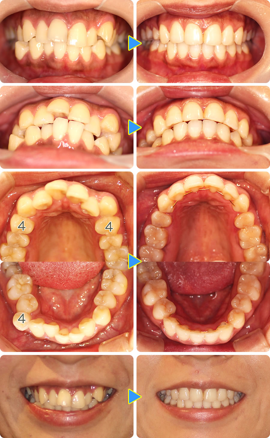 八重歯を部分矯正治療前後写真・抜歯アリ