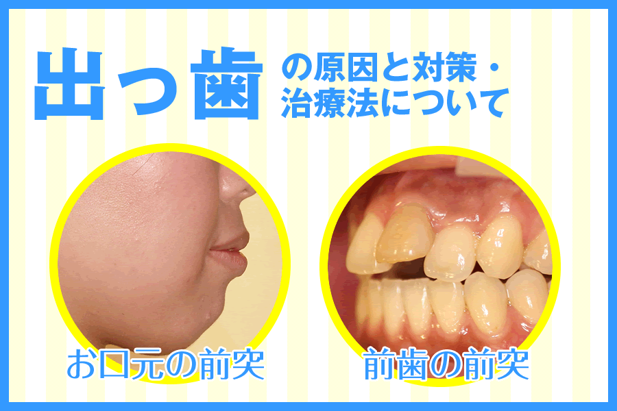 出っ歯の治療法