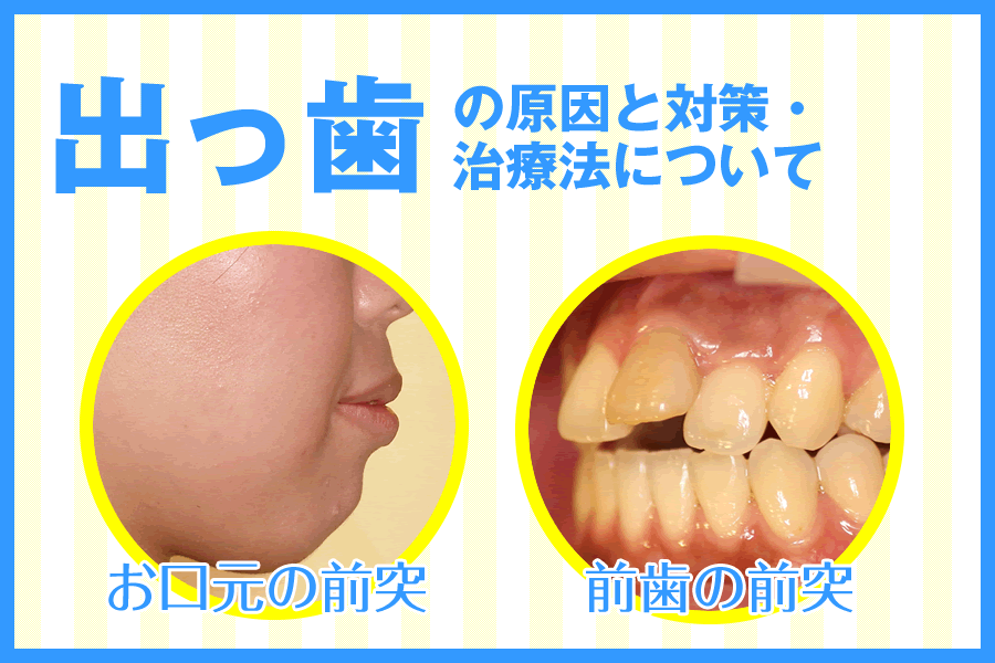 出っ歯を治す方法 出っ歯のタイプ別原因と対策 矯正治療について