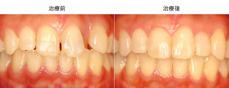 舌側転移・空隙歯列の治療前後写真