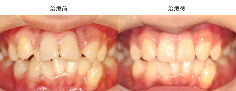 前歯前突・叢生・抜歯の部分矯正症例