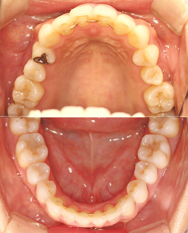 咬合面・治療後