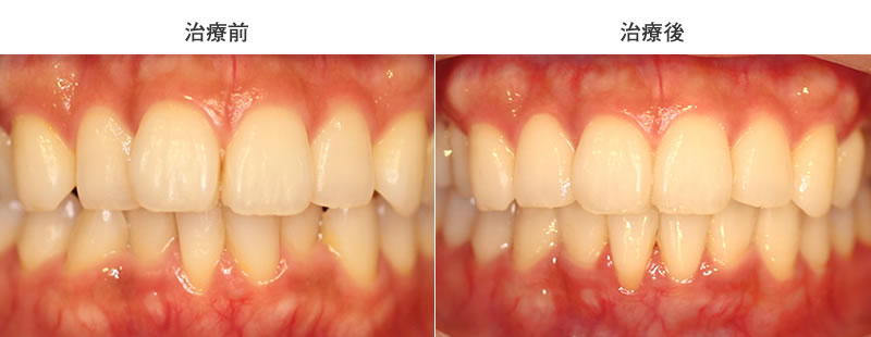 上下前歯の叢生を部分矯正した治療前後写真