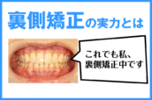 “歯科矯正の見た目が気になる人必見！裏側矯正の実力とは”はロックされています。 歯科矯正の見た目が気になる人必見！裏側矯正の実力とは