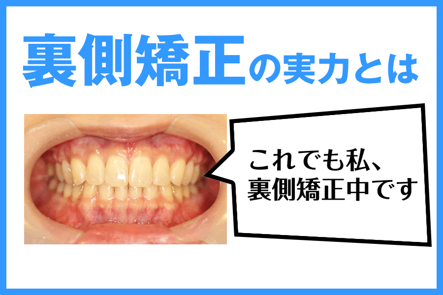 “歯科矯正の見た目が気になる人必見！裏側矯正の実力とは”はロックされています。 歯科矯正の見た目が気になる人必見！裏側矯正の実力とは