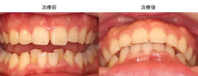 上下リンガル矯正・治療前後写真