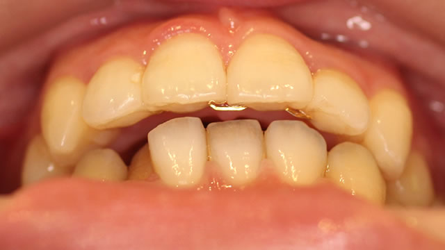 八重歯の部分矯正治療後写真・下から