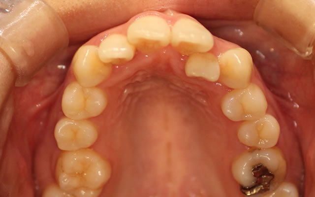 八重歯の部分矯正治療前写真・咬合面