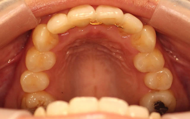 八重歯の部分矯正治療後写真・咬合面