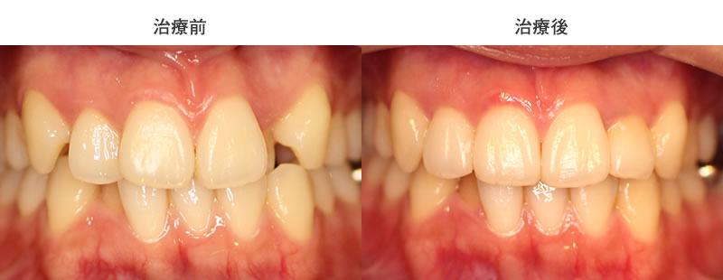 八重歯の部分矯正治療前後写真
