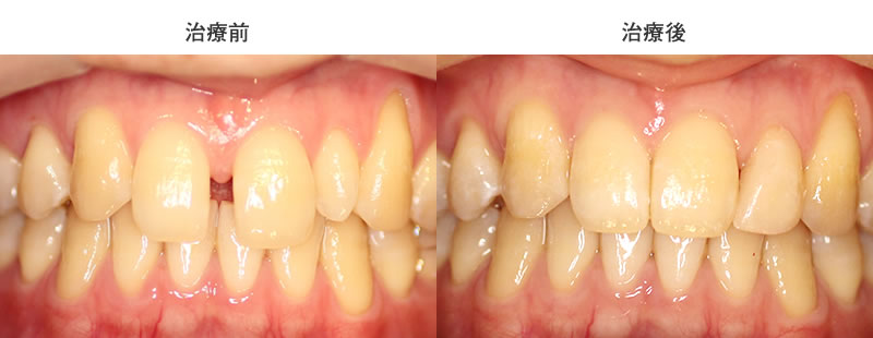 すきっ歯・部分矯正治療前後写真