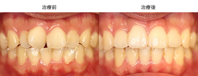 ウィンギング矯正治療前後写真