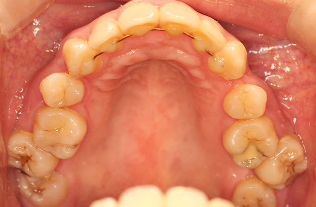 矯正治療後・咬合面（上）