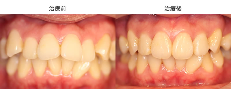 出っ歯矯正治療前後の正面写真