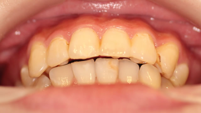 八重歯の部分矯正治療後（下から）