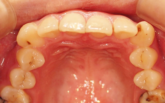 八重歯の部分矯正治療前（咬合面）