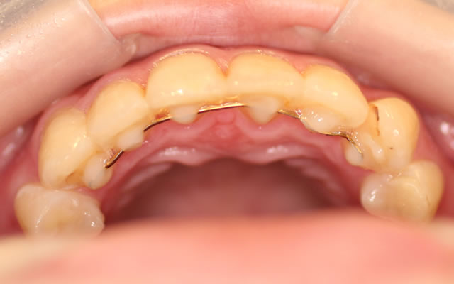 八重歯の部分矯正治療後（咬合面）