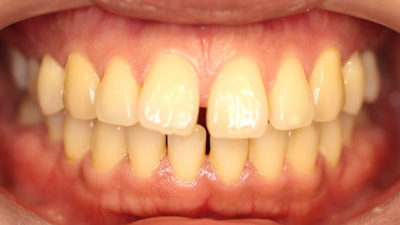 すきっ歯の部分矯正治療前写真