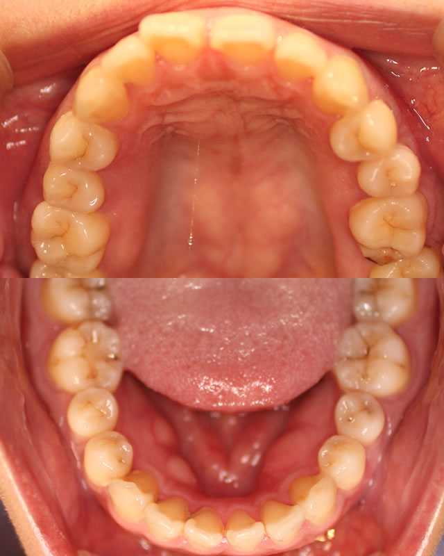 すきっ歯の矯正前写真（咬合面）