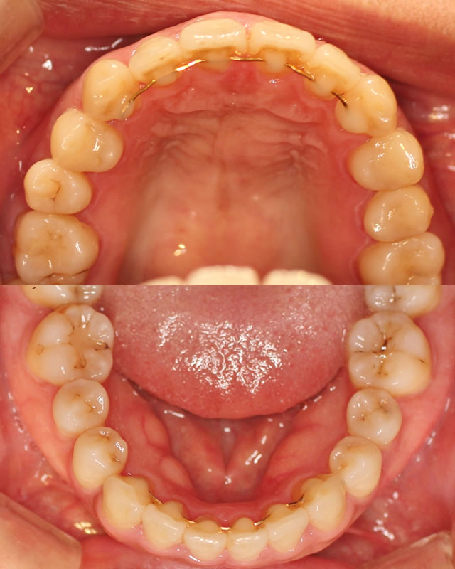 すきっ歯の矯正後写真（咬合面）