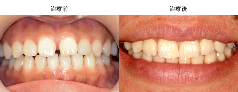 すきっ歯を補綴で治療した症例（ノブデンタルオフィス）