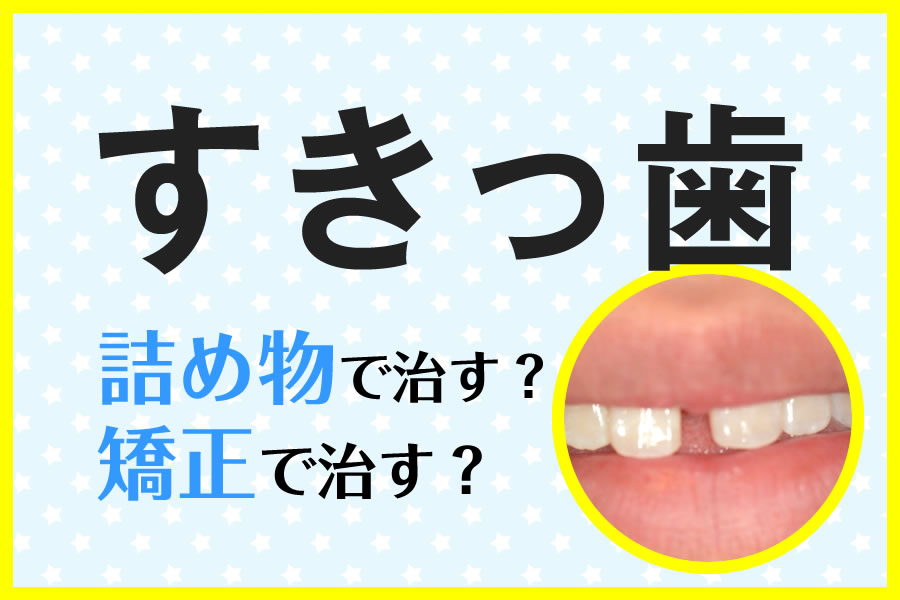 すきっ歯 を矯正治療で治すメリット デメリット 費用や期間の比較