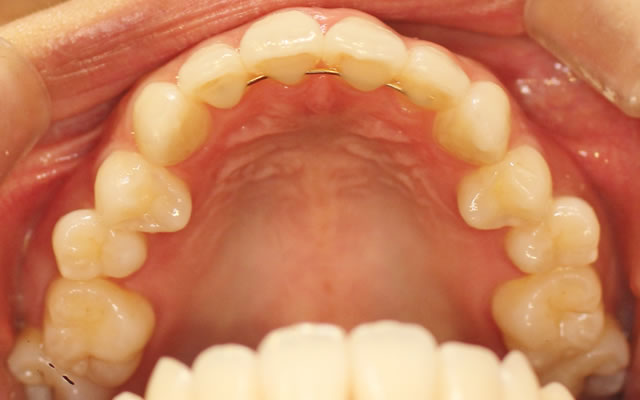 反対咬合の治療後（咬合面・上）