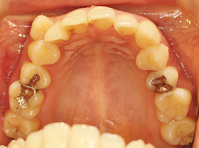 正中ずれ・反対咬合の治療前（咬合面・上）