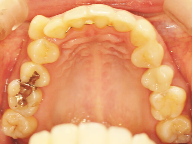 正中ずれ・反対咬合の治療後（咬合面・上）
