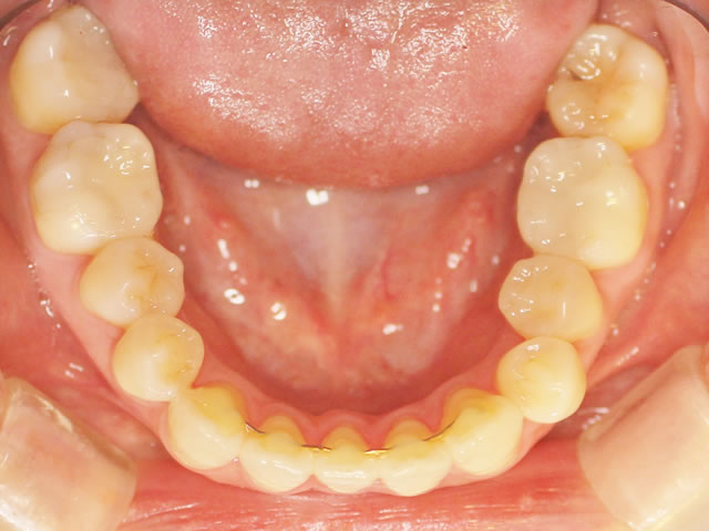 正中ずれ・反対咬合の治療後（咬合面・下）