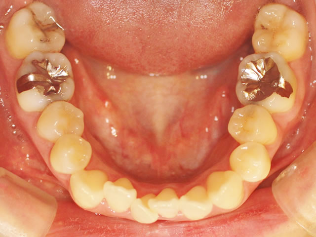 正中ずれ・反対咬合の治療前（咬合面・下）