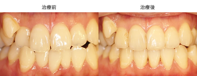 前歯のズレ・反対咬合を部分矯正した症例