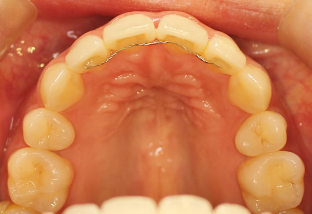 部分矯正前（咬合面・上）