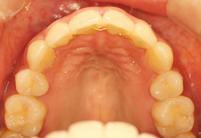 部分矯正後（咬合面・上）