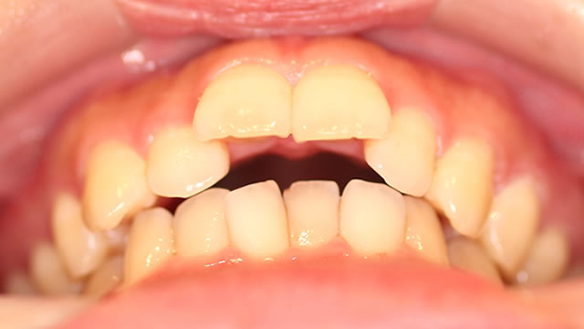 軽度な出っ歯の部分矯正前・下から