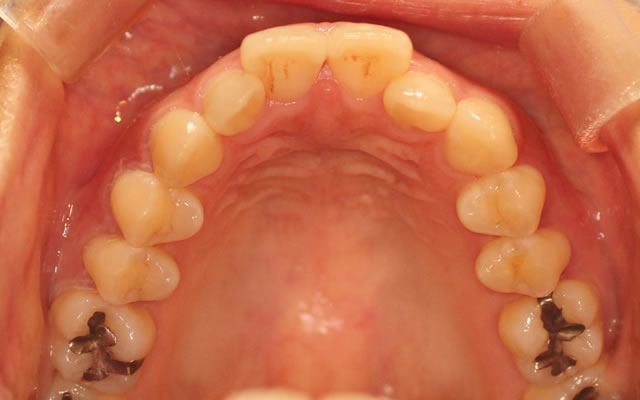 軽度な出っ歯の部分矯正前・咬合面