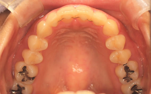 軽度な出っ歯の部分矯正後・咬合面