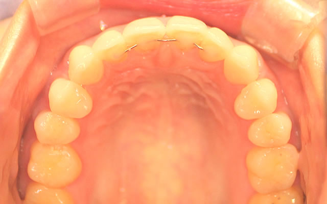 上の歯の咬合面（治療後）
